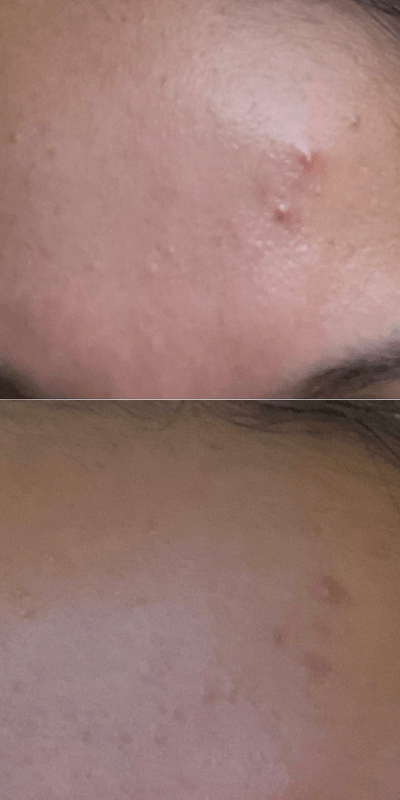 Charcoal mask before and after