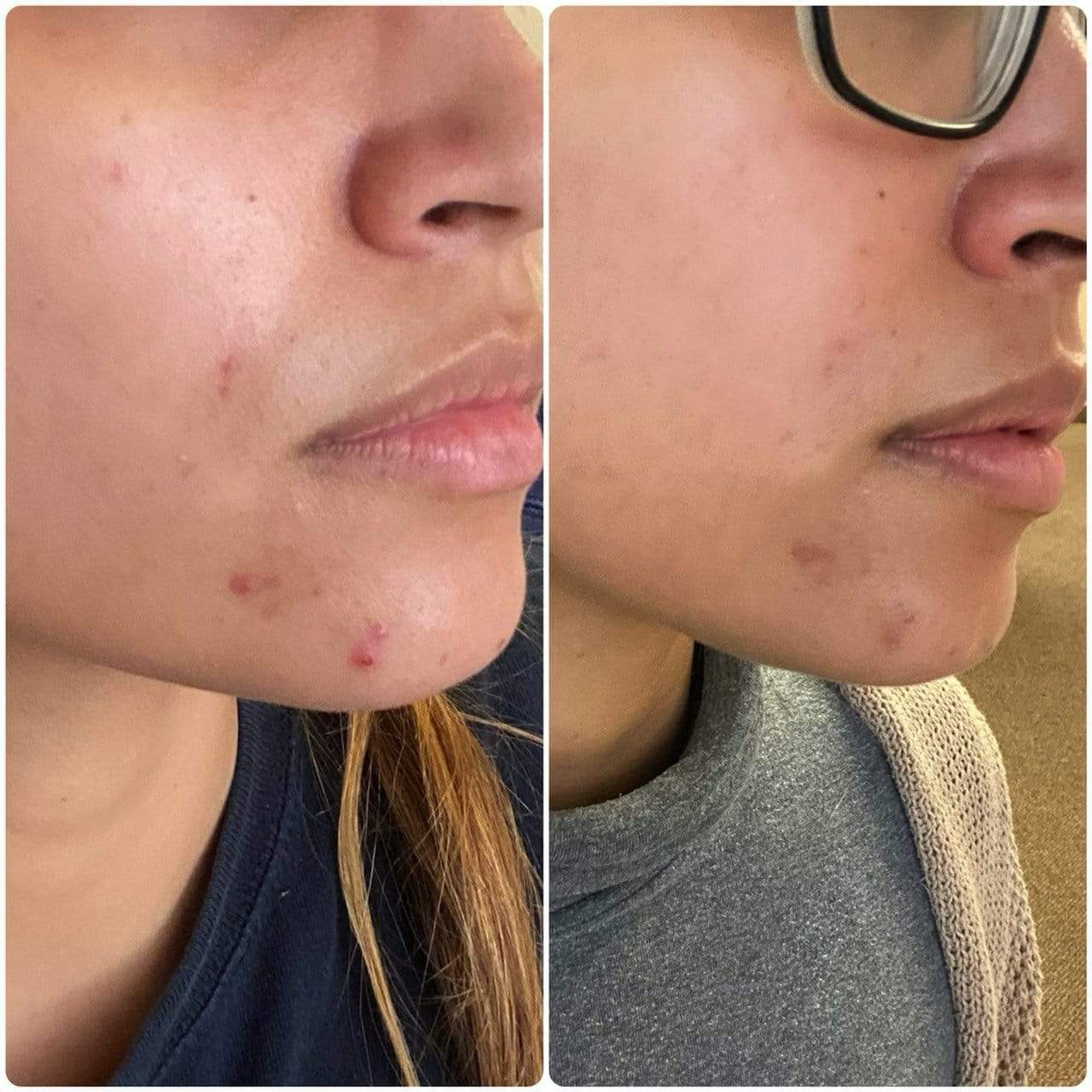 acne free before and after image