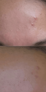 Charcoal mask before and after