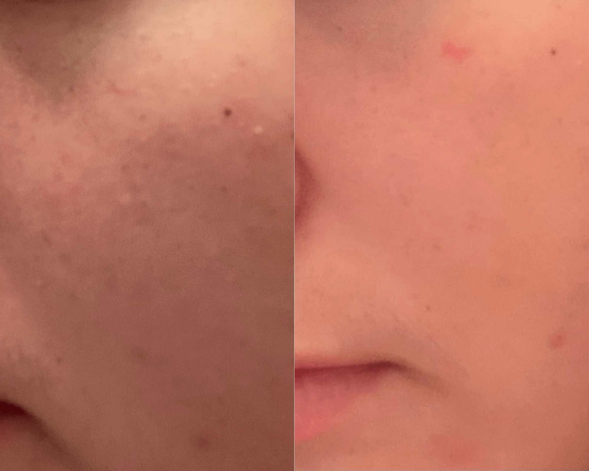 Clear skin before and after 