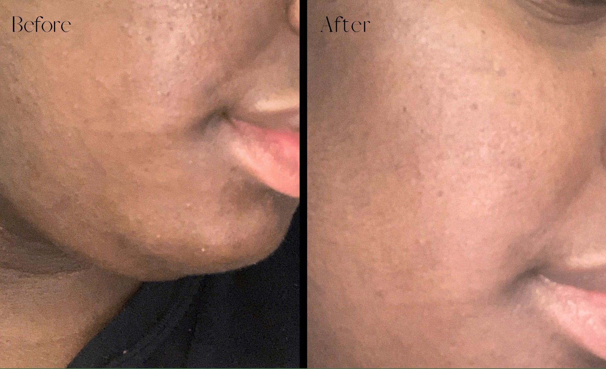 before and after done by charcoal mask